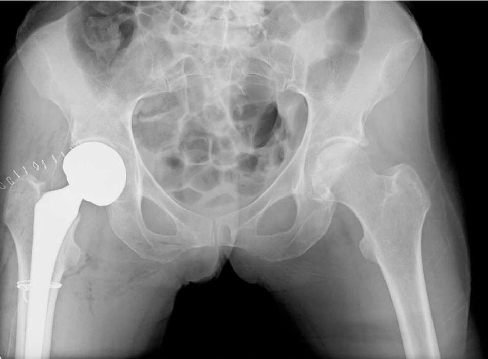 SYMPTOMS and METHODS of TREATMENT of FRACTURE of THE FEMORAL NECK