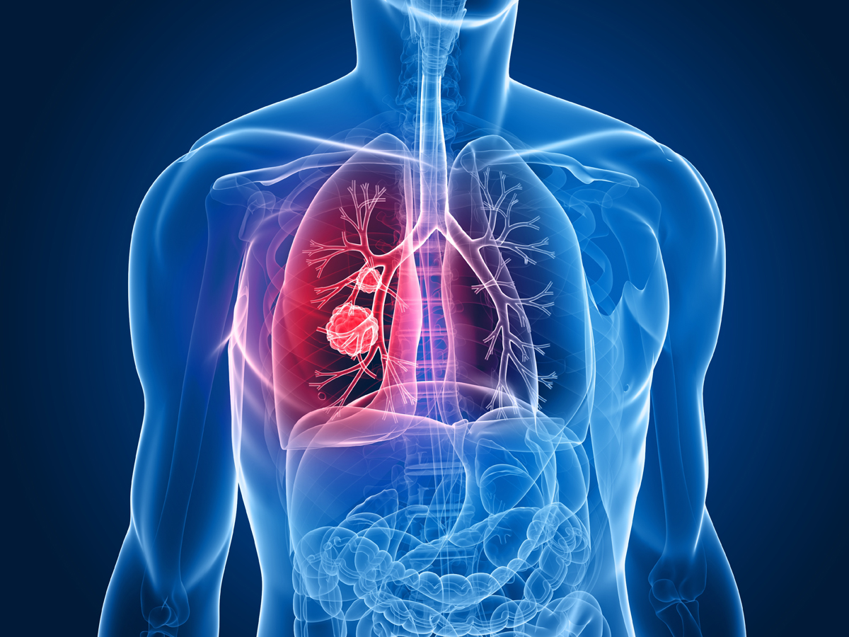 Five Signs of Lung Cancer That Are Easy to Ignore!