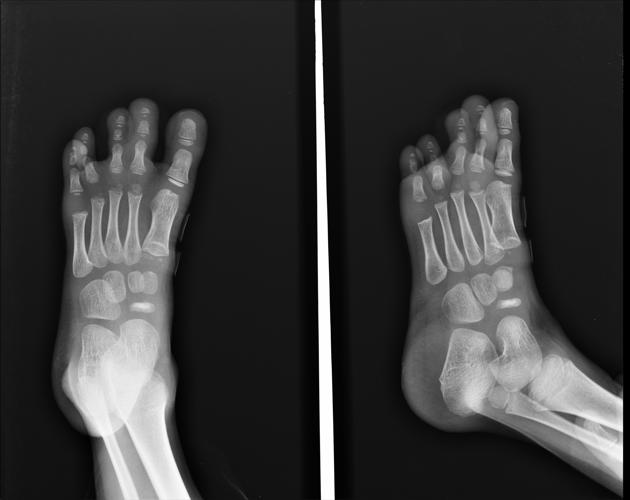 How to Detect Osteochondrosis!