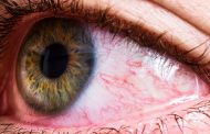 Several Ways to Eliminate Redness of the Eyes at Home