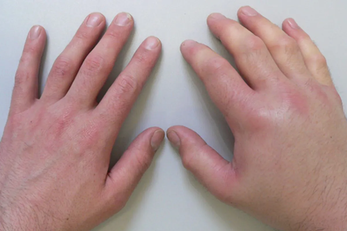Swelling of the body or swelling in certain parts of it can signal fluid retention in the body
