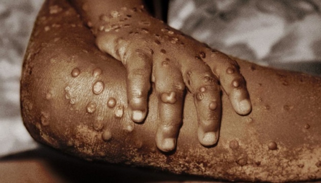 Monkeypox has been reported in 14 countries