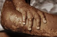 US emergency center opens for monkeypox patients