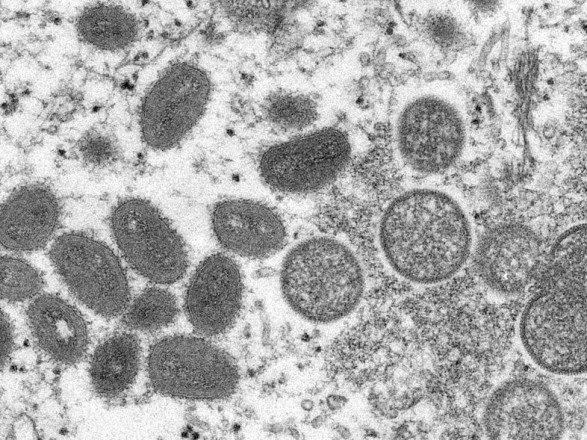 WHO: Monkeypox is not yet an emergency