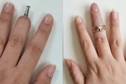 Finger Replacement via Dental Implant