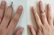 Finger Replacement via Dental Implant