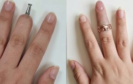 Finger Replacement via Dental Implant