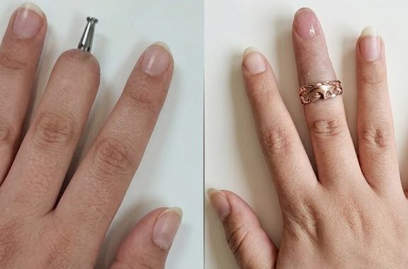 Finger Replacement via Dental Implant
