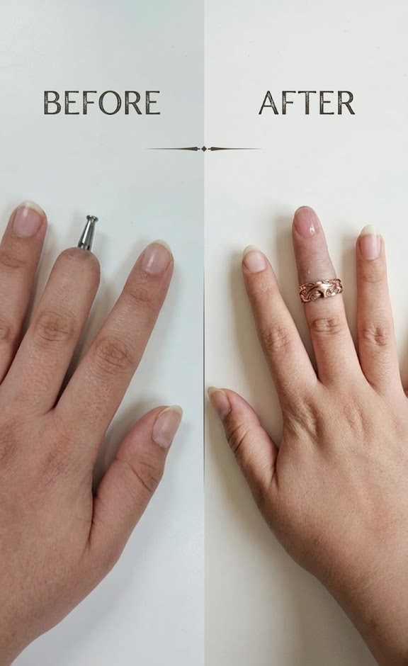Finger Replacement via Dental Implant