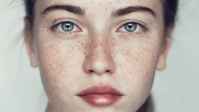 كيف تتخلصين من النمش في المنزل وبشكل نهائي